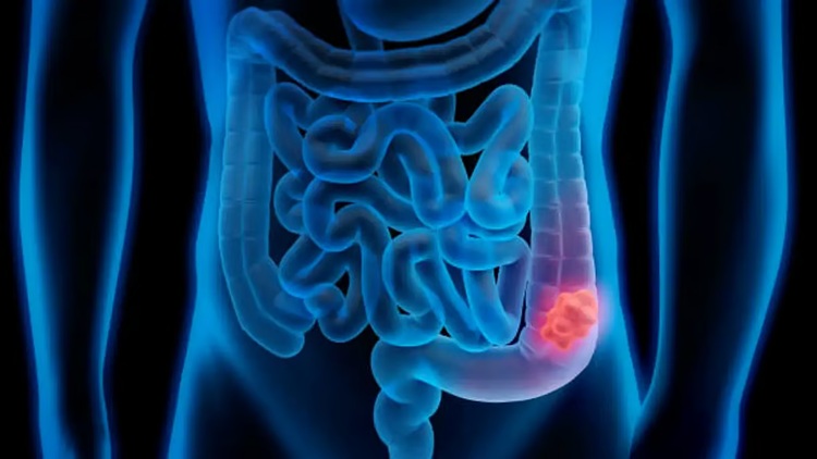 colorectal cancer